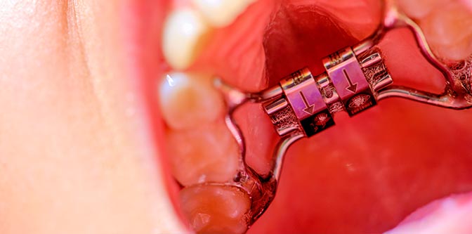 Fixed-Expansion-Devices